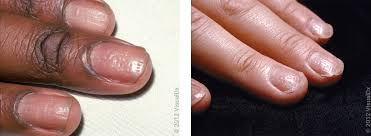 Image result for Nail Pitting