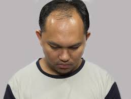 Try sleeping in a satin cap or with a satin pillowcase, to avoid pulling or breaking the hair at night. Male Pattern Baldness Treatment Homeopathic Remedies At Health Total