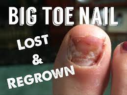 Big Toe Nail Loss And Re Growth Over 8 Months Toe Nails Big Toe Nail Growth