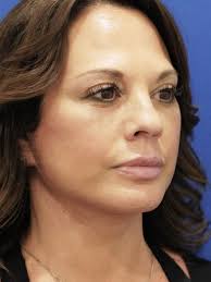 Cases in Buccal Fat Excision