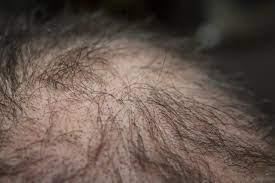 This gives the reader information of how magnesium can help with hair loss, with examples of the author's own experiences with the subject. Increase Your Hair Growth The 12 Week Transdermal Magnesium Challenge Peakd