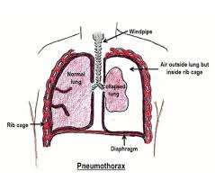 Image result for Open Pneumothorax