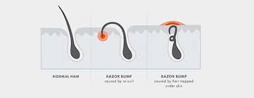 Razor Bumps: How To Prevent Ingrown Hairs | Gillette Uk