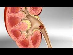 Dissolve Gallstones Naturally 5 Most Effective Ways In 2020 Kidney Transplant Kidney Disease Stages Kidney Infection