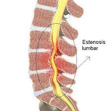 Es sumamente importante tratar este tipo de afección de inmediato. Dr Mosqueira Clinica Estenosis De Canal Lumbar Los Problemas De Columna Cervical Y Lumbar Estan Entre Las Afecciones Mas Comunes Que Sufren Las Personas De Mas De 65 Anos Pero La