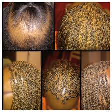 No, box braids do not damage the hair. More Stylists Sharing Photos Of Braid And Weave Work On Balding Clients Confidence Booster Or Bad Practice Bglh Marketplace