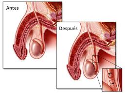 Tener una vasectomía siempre debe verse como una medida permanente. Centro Andrologico Recoleta Vasectomia Anticonceptivo Masculino