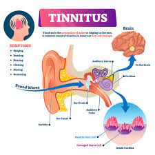 Labyrinthitis symptoms include ear pain or earache, dizziness, nausea, vomiting, vertigo, and tinnitus. Causes Remedies Of Tinnitus Spikes Hearing Health Usa