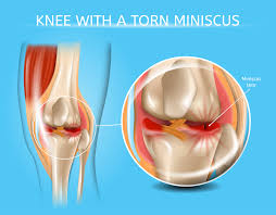 Pseudo locked knee is most often resolved by effective management of the pain. Meniscus Tear Repair Direct Orthopedic Care