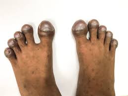 Image result for Koilonychia feet