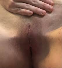genital nullification : rtransbodymods