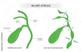 Image result for acholic stools human