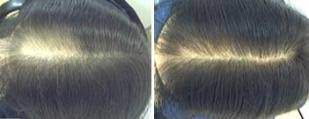 Having a higher number of cuticles that protect the hair shaft increases elasticity and allows for more flexibility and bend in the hair shaft, which makes the hair more. Treating Asian Hair Loss
