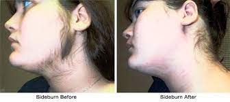 This doesn't mean you have to attend a salon. Facial Waxing 15 Lip Wax 5 Ear Nose Wax 5 Chin Wax 5 Female Facial Hair Facial Waxing Female Sideburns