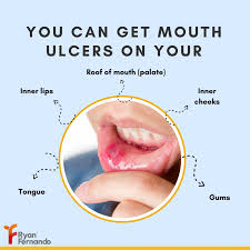 Image result for Mouth ulcers roof of mouth