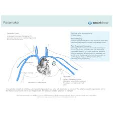 Pacemaker