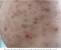 Eruptive Vellus Vellus Hair Cyst