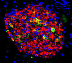 Mar 24, 2021 · in addition to lifestyle changes, patients who are newly diagnosed with type 2 diabetes are often prescribed an oral drug called metformin. Protein Finding Could Inform New Type 2 Diabetes Treatment Cornell Chronicle