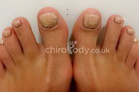Great savings & free delivery / collection on many items. Toenail Reconstruction Cosmetic Podiatry Treatments Chiropody Co Uk Leading Chiropodist Podiatrists In Manchester And Liverpool
