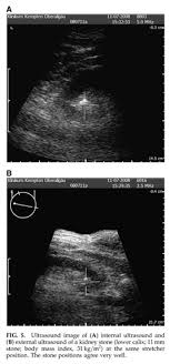 Gale Onefile Health And Medicine Document Ultrasound Monitoring Of Kidney Stone Extracorporeal Shockwave Lithotripsy With An External Transducer Does Fatty Tissue Cause Image Distortions That Affect Stone Comminution