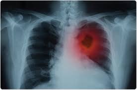Your lungs help you and provide oxygen throughout your there are several types of lung cancer, but the most common types are named according to the size of cells in cancerous tumors. Potential New Metabolic Biomarkers Of Lung Cancer Identified