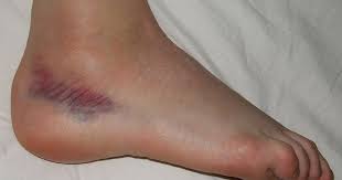 Pembengkakan kaki secara bertahap, juga dikenal sebagai edema, bisa menjadi tanda adanya kondisi medis. Kaki Terseliuh Cara Rawatan Dan Punca The Diagnosa