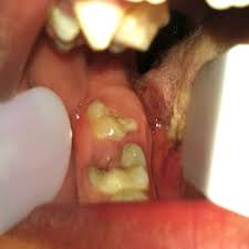 Image result for spinocellular carcinoma of the oral cavity