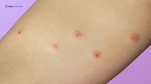 Image result for scabies bite