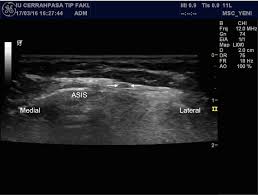 Check spelling or type a new query. Ultrasound Guided Diagnosis And Injection Of The Lateral Femoral Cutaneous Nerve With An Anatomical Variation Palamar 2017 Pain Practice Wiley Online Library