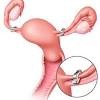 A vasectomy doesn't provide immediate protection against pregnancy. 1