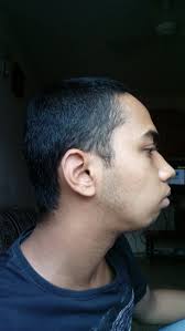 Recessive Lower Jaw In Kids | Hometown Orthodontics