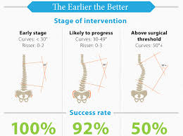 7 types of scoliosis their differences comprehensive guide