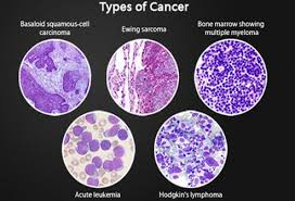 Learn more about the symptoms, diagnosis, and treatment. Hodgkin S Vs Non Hodgkin S Lymphoma Symptoms Treatment Causes