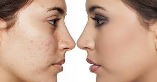 Sirf Raat Bhar Main Chehray ke Dano Se Mukamal Chutkara, Sirf Raat Bhar  Main Chehray Ke Dano Se Mukamal Chutkara