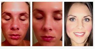 Black And White Bleaching Cream Side Effects Pin On Mask Of Pregnancy