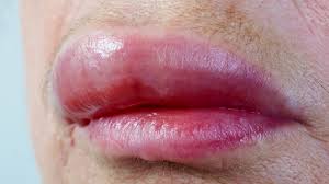 Image result for Angioedema