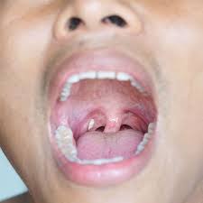 When not mineralized, the presence of debris is known as chronic caseous tonsillitis (cct). Do Tonsil Stones Cause Bad Breath Smartmouth