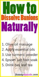 How To Dissolve Bunions Naturally Beautymunsta Free Natural Beauty Hacks And More Bunion Remedies Get Rid Of Bunions Bunion
