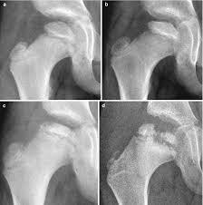 Note that the femoral head is completely contained inside the hip cup. Legg Calve Perthes Disease Springerlink
