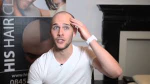 In men, hair often begins to recede at the hairline on the forehead. What To Do If You Are Losing Your Hair At A Young Age Scalp Micropigmentation At Scalp Clinic Youtube