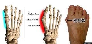 In this video, karuna offers a sequence to alleviate pain from bunions as we. 9 Yoga Bunions Ideas Bunion Yoga Feet Care