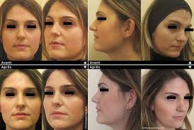 If you have any questions, please call customer. Injections D Acide Hyaluronique A Quel Age Commencer Dr Benouaiche