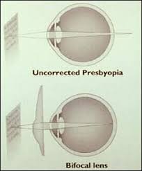 Image result for Presbyopia