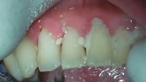 We did not find results for: Teeth Cleaning Guide Tartar Removal And Dental Costs