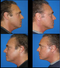 Macs Lift Before And After Male Plastic Surgery Gynecomastia Plastic Surgery