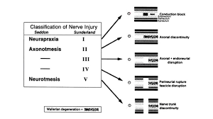 Peripheral nerve injuries encompass a range of reversible and irreversible impairments determined by injury level, axonal disruption irreversible. Peripheral Nerve Injury Principles Of Repair Waleed Haddad