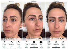 See full list on webmd.com La Roche Posay Launches Effaclar Adapalene Gel 0 1 Acne Treatment Allure