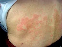 How does the tst work? Down The Rabbit Hole Cutaneous Tuberculosis The American Journal Of Medicine