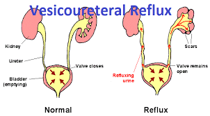 Vesicouretal Reflux Abnormal Retrograde Movement Of Unrine From Bladder To Ureters And Then Kidneys Sig Kidney Failure Causes Reflux Urinary Tract Infection