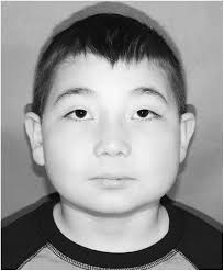 Innovative Surgical Treatment of Severe Cherubism